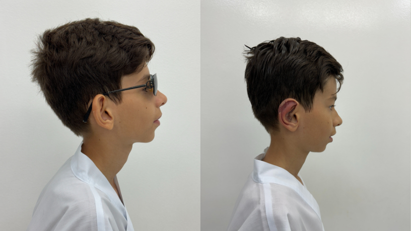 Entenda com o Dr. Milton Seigi Hayashi como a otoplastia transforma o convívio social das crianças.
